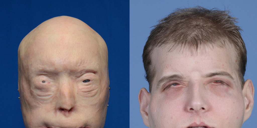 Feuerwehrmann Patrick Hardison vor und nach der komplexen Operation. Feuerwehrmann Patrick Hardison vor und nach der komplexen Operation.