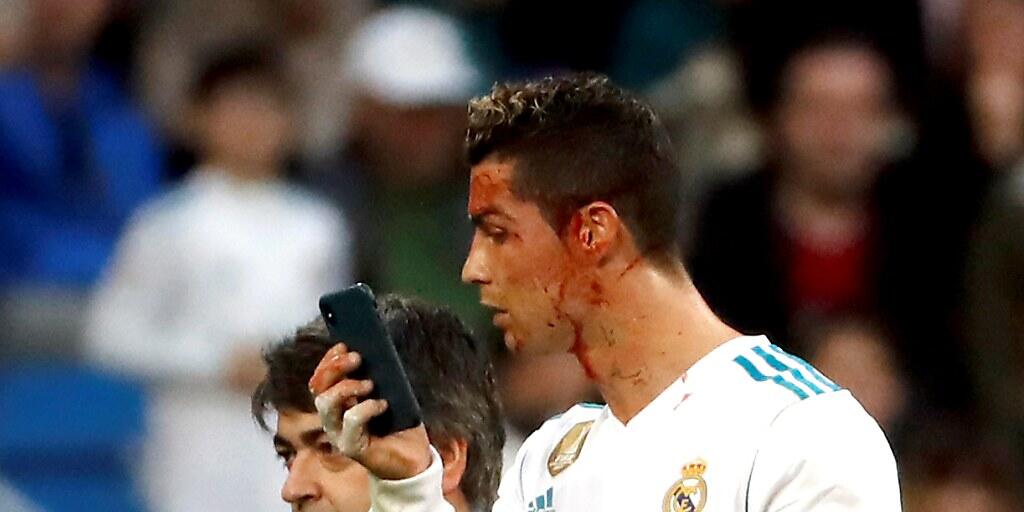 Cristiano Ronaldo mit blutverschmiertem Gesicht im Spiel gegen La Coruña
